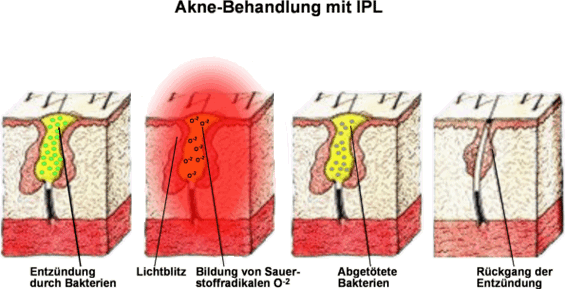 Akne Behandlung mit IPL